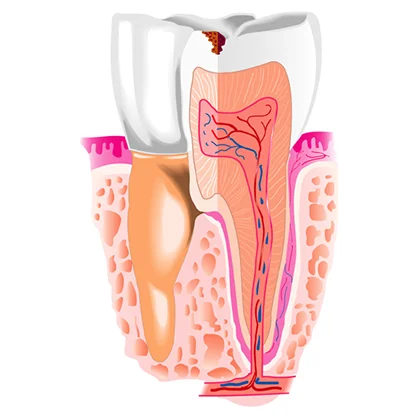 зубна накладка керамічна пломба