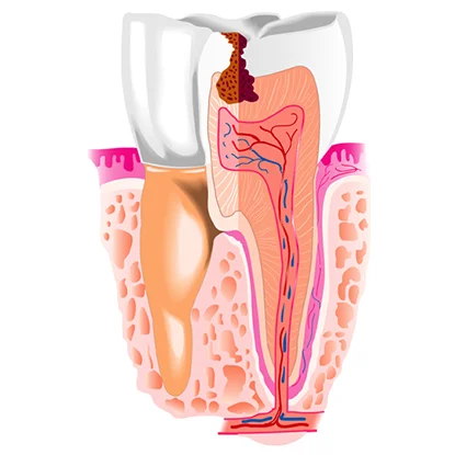 керамічна пломба накладка на зуби