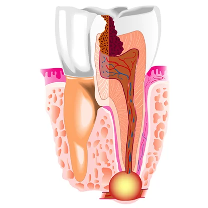 коронка на зуби