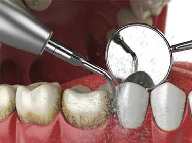 Ультразвукова чистка зубів