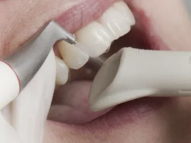 Чистка зубів AirFlow