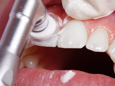 Полірування зубів