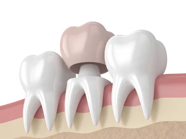 зубна коронка