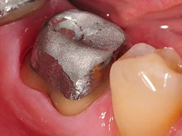 культя зуба пеньок вкладка металева