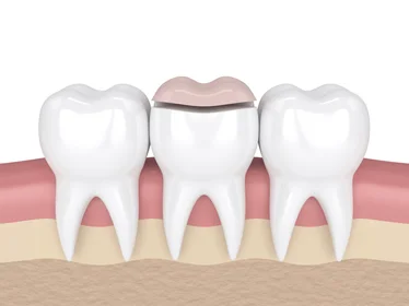 керамічна накладка на зуб (onlay)