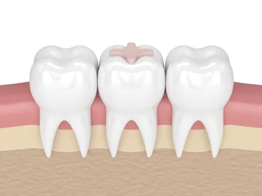 керамічна вкладка на зуб (inlay)
