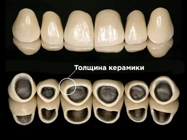 коронка металокераміка