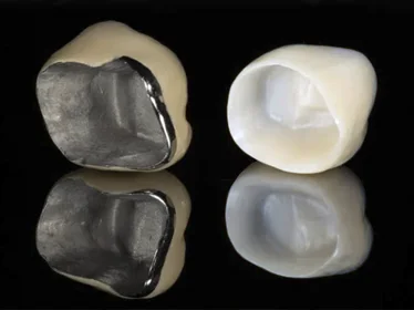 цирконієва та металокерамічна коронка