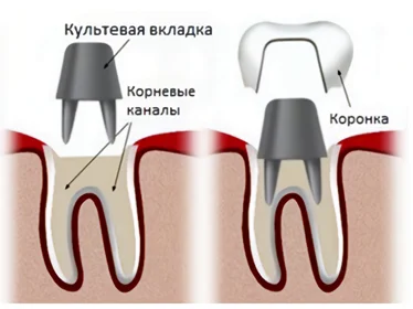 культова вкладка зуба