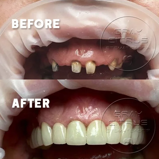 приклад роботи — коронки на зуби