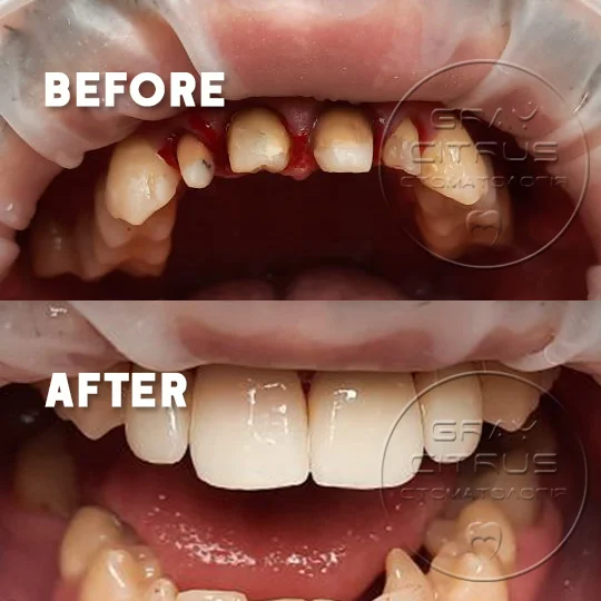 приклад роботи — протезування коронками