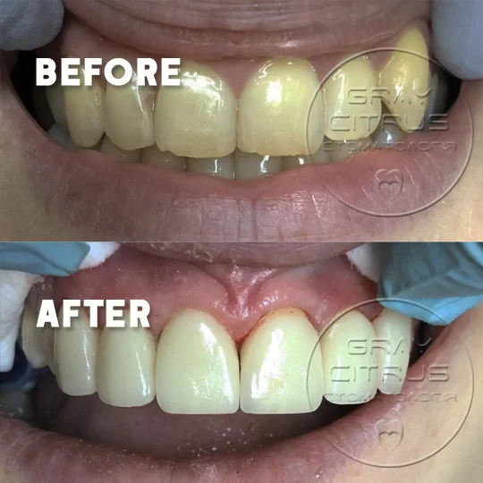 приклад роботи — цирконієва коронка