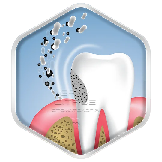 Захист зубів від карієсу та ослаблення емалі