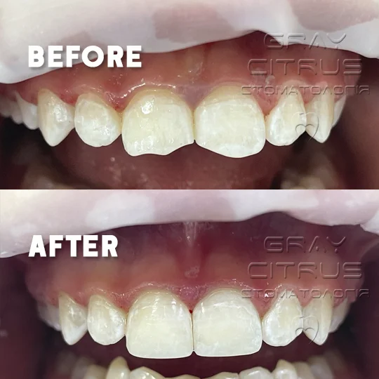 фотополімерна реставрація зубів ціна Київ Позняки