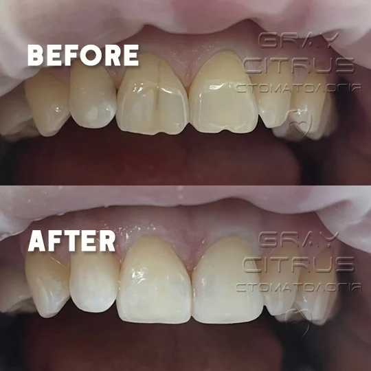 композитна реставрація зубів Київ Позняки