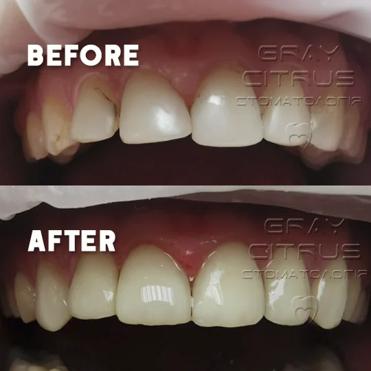 реставрація передніх фронтальних зубів на позняках