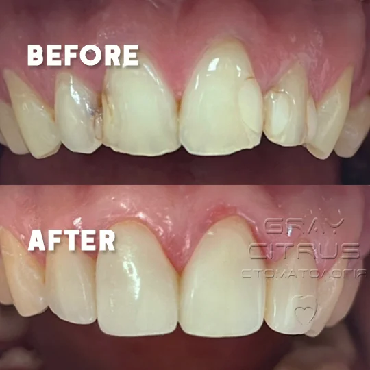 естетична реставрація передніх зубів на пізняках ахматової григоренка урловська