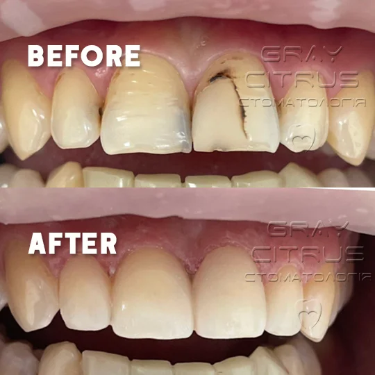 нарощування передніх фронтальних зубів у Києві