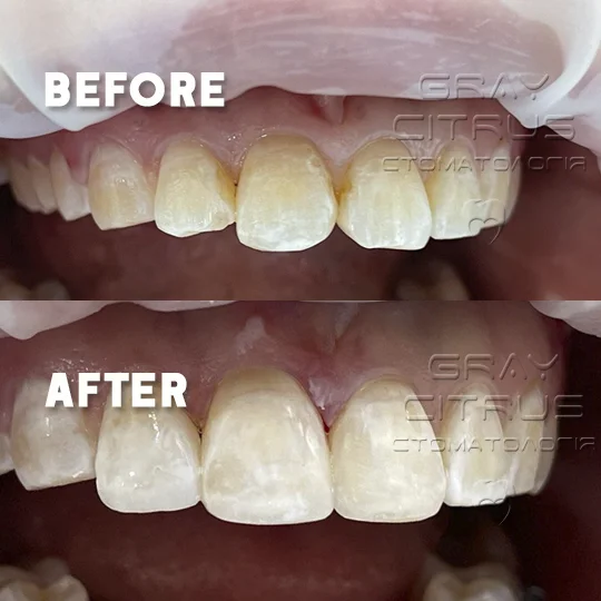 нарощування та реставрація передніх зубів у Києві