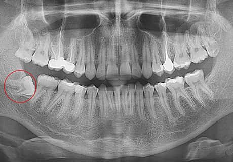 неправильно розташований зуб мудрості атипове видалення