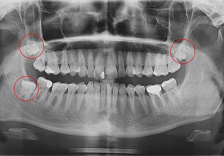 ретенований зуб мудрості видалення не виріс повністю